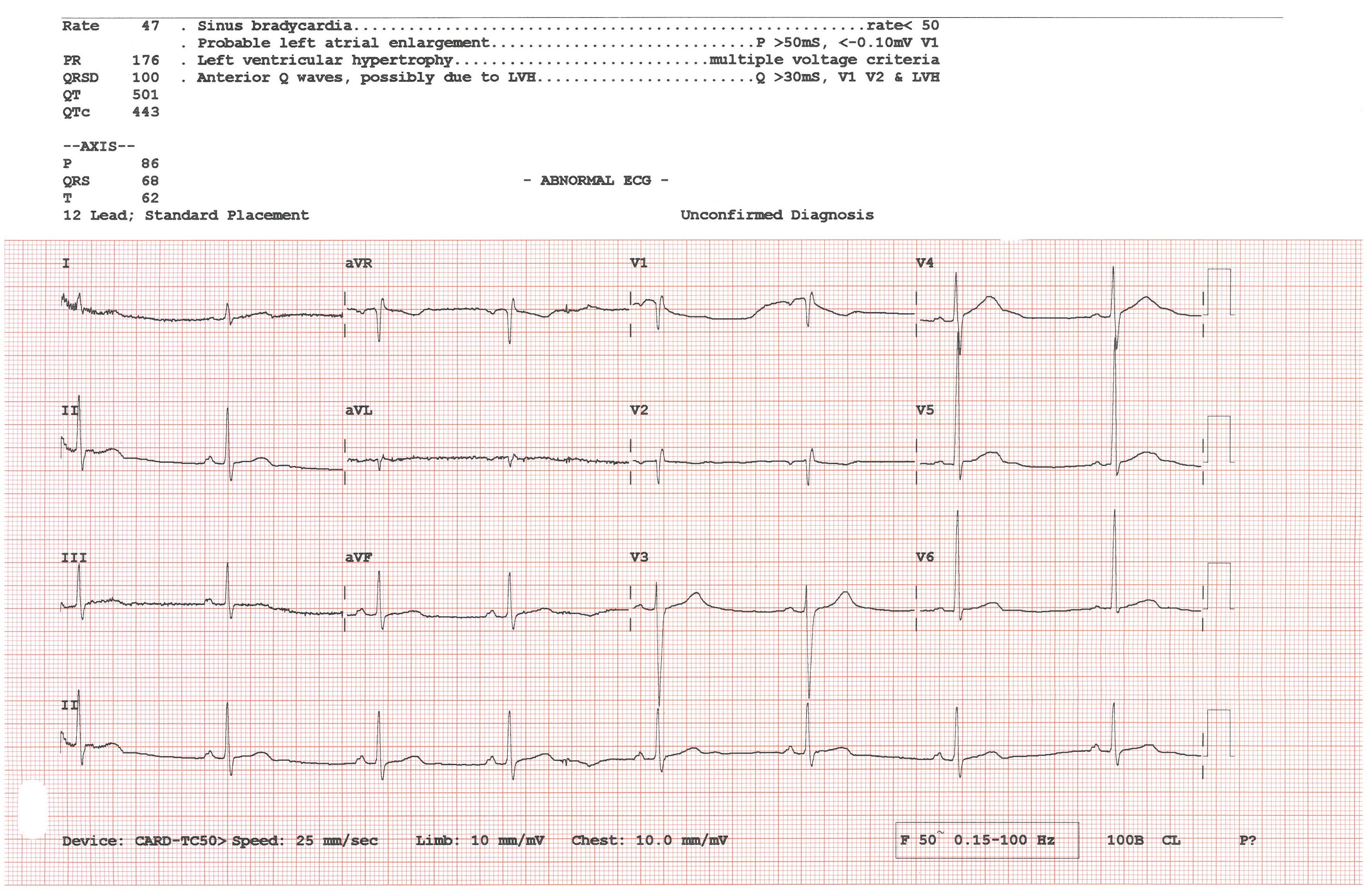 Brytyjski system AI odczytuje EKG w dwie sekundy i wykrywa ukryte choroby serca
