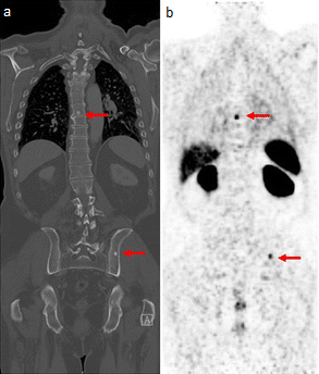 AI Model DiffuDose Calculates Targeted Radiotherapy Dose in 23 Seconds Instead of Hours
