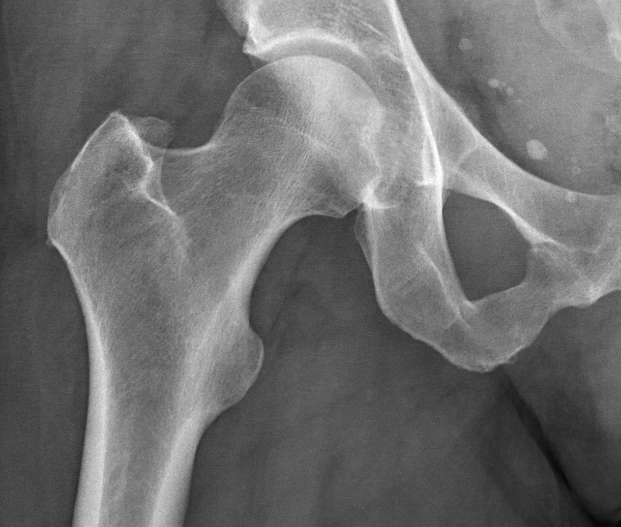 Swedish AI Model Predicts Hip Fractures Years Before They Happen