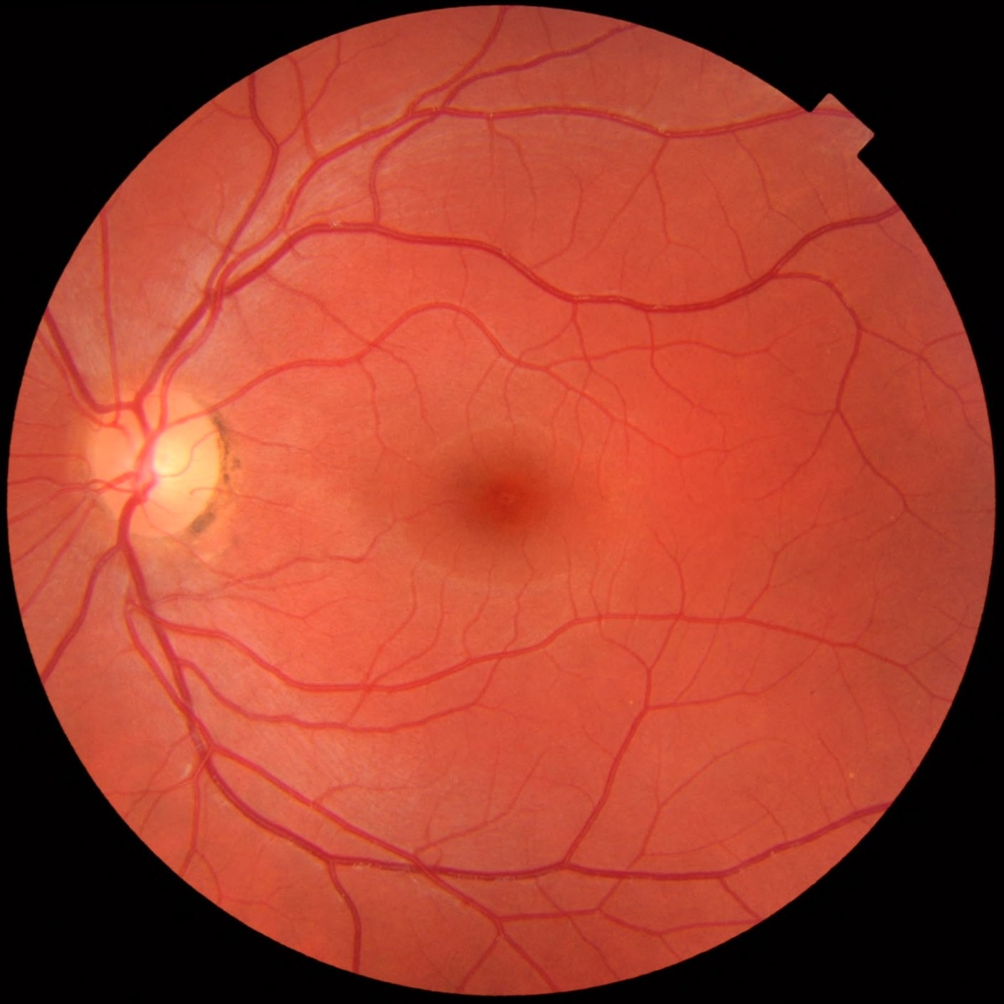 AI System Retina4IRD Accurately Identifies Genes Behind Rare Retinal Diseases